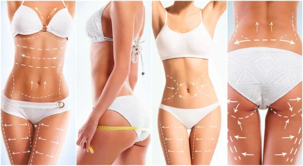 What to Expect from Full-Body Liposuction in Turkey: Cost, Recovery & Results