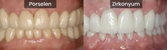 Key Differences Between Zirconium and Porcelain Veneers