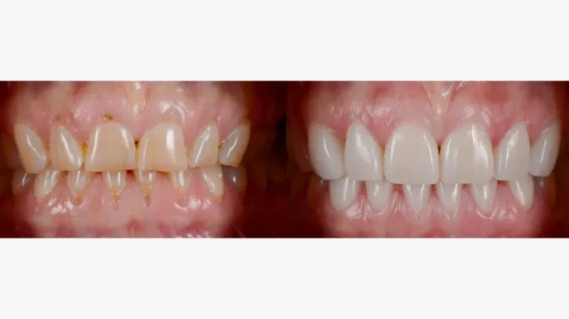 Advantages of Porcelain Veneers