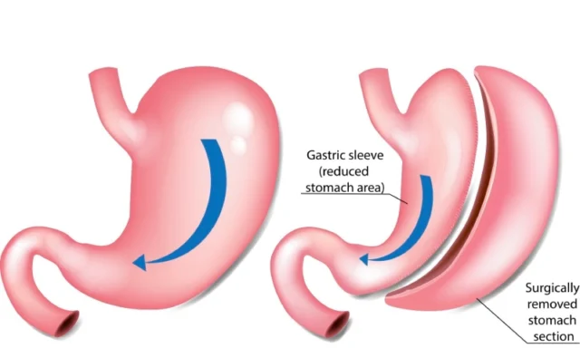 Benefits of Gastric Sleeve Surgery